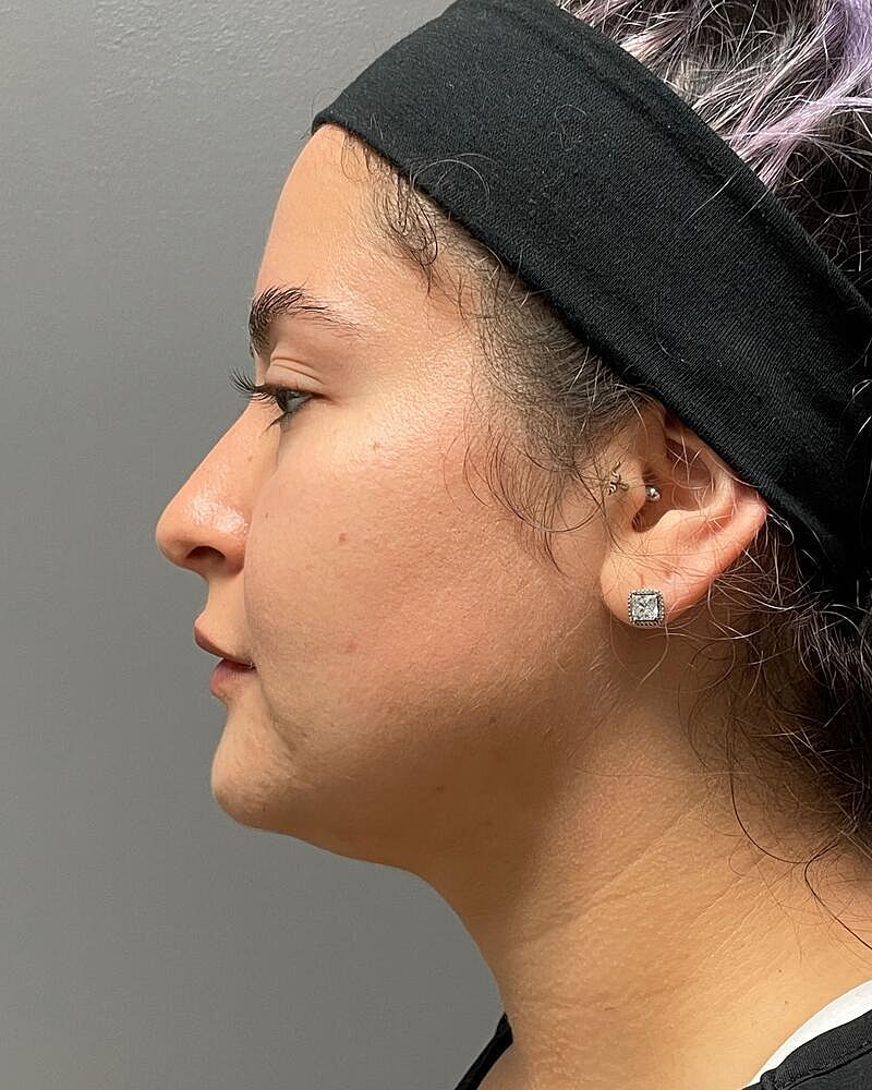 Buccal Fat Removal Before & After