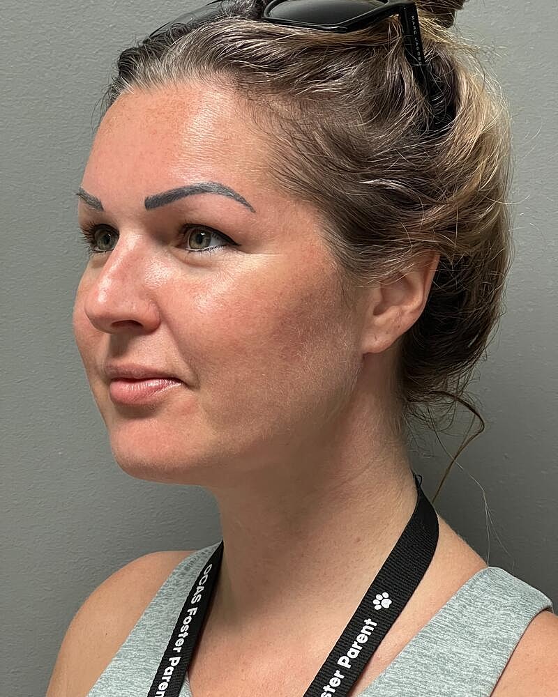 Buccal Fat Removal Before & After