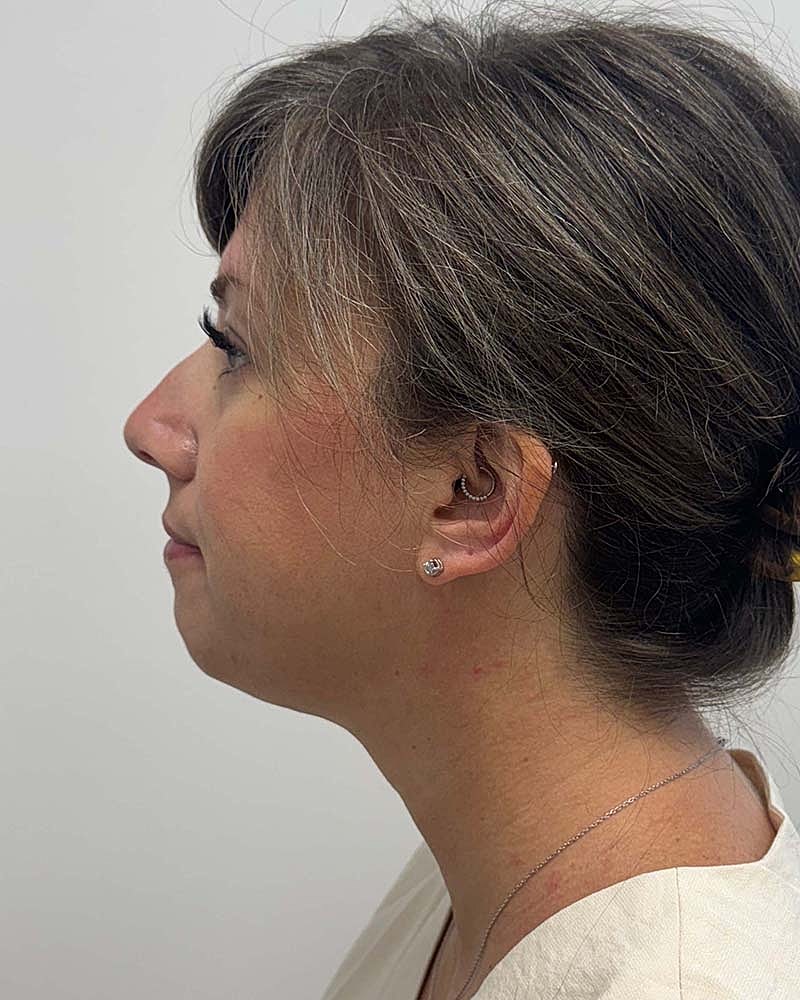 Chin Liposuction Before & After