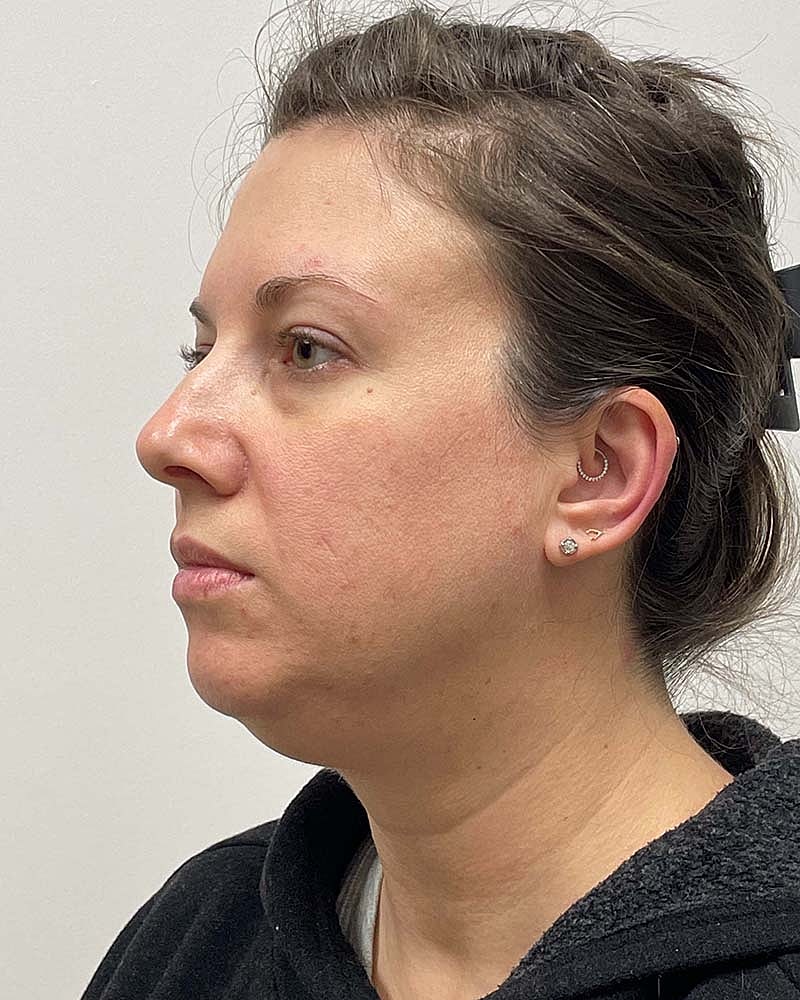 Chin Liposuction Before & After