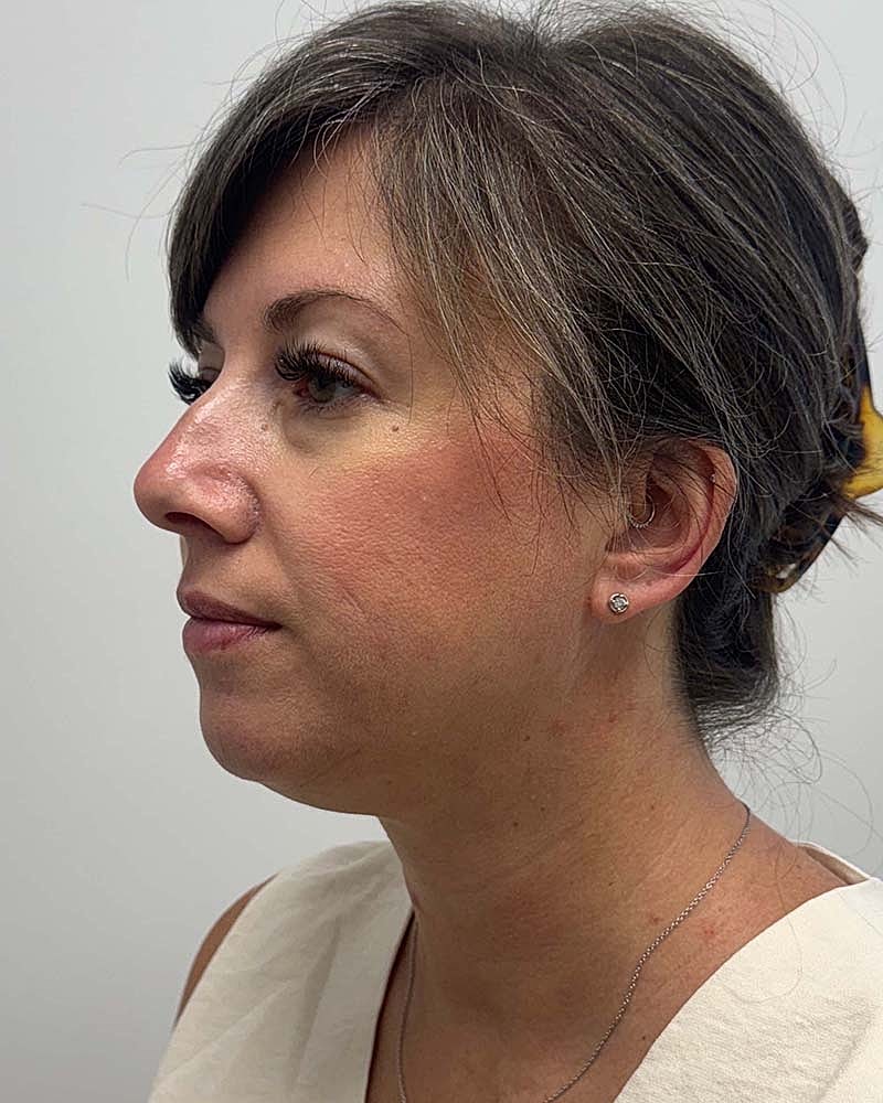 Chin Liposuction Before & After