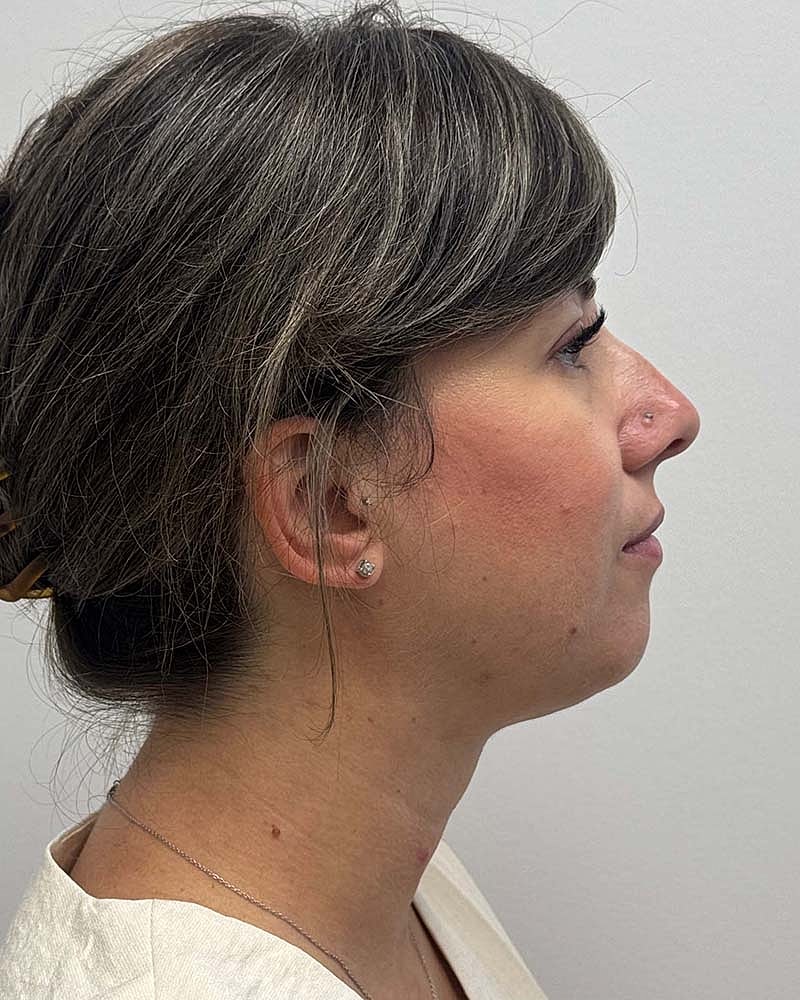 Chin Liposuction Before & After