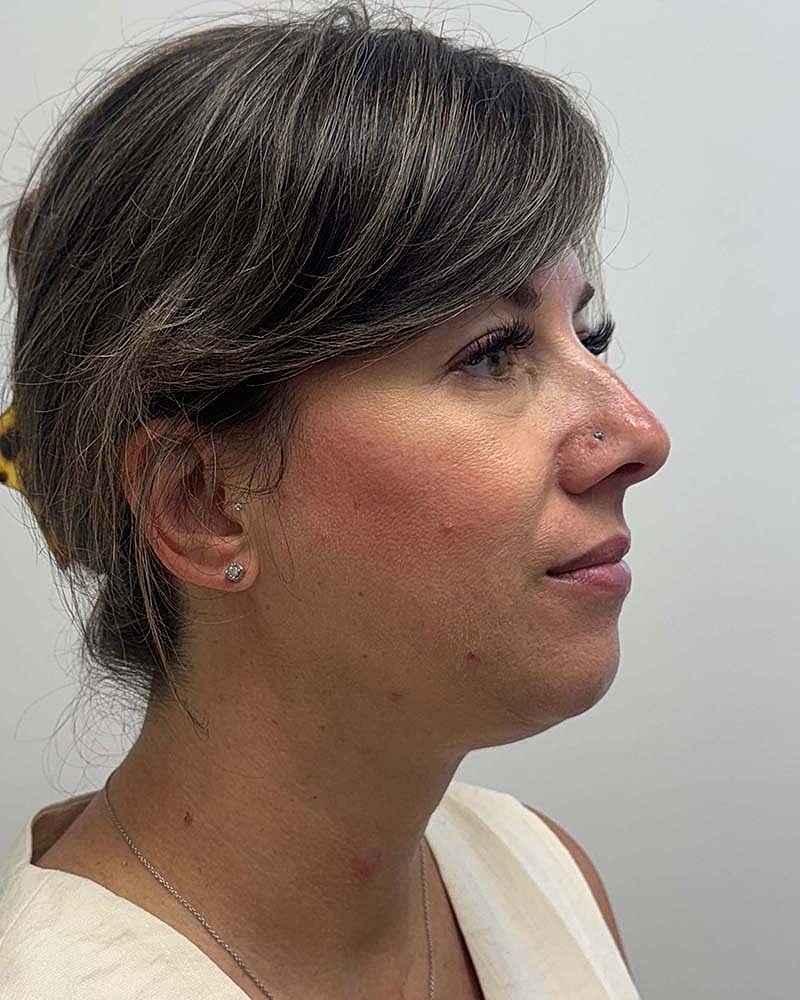 Chin Liposuction Before & After