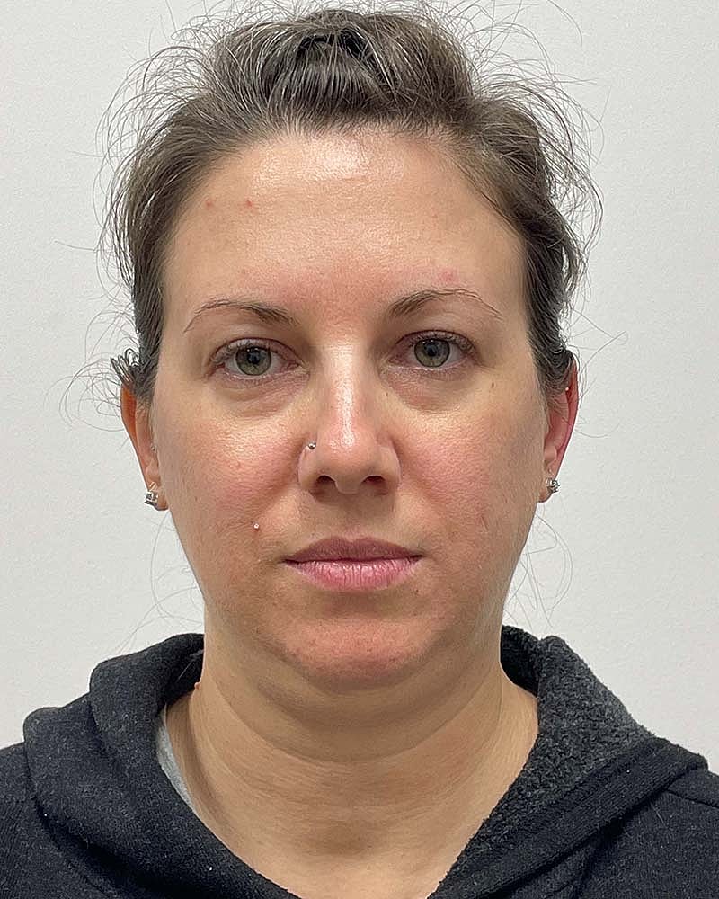 Chin Liposuction Before & After
