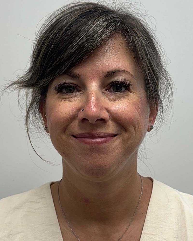 Chin Liposuction Before & After