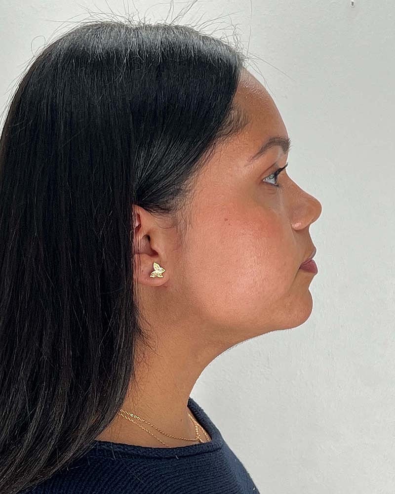 Chin Liposuction Before & After
