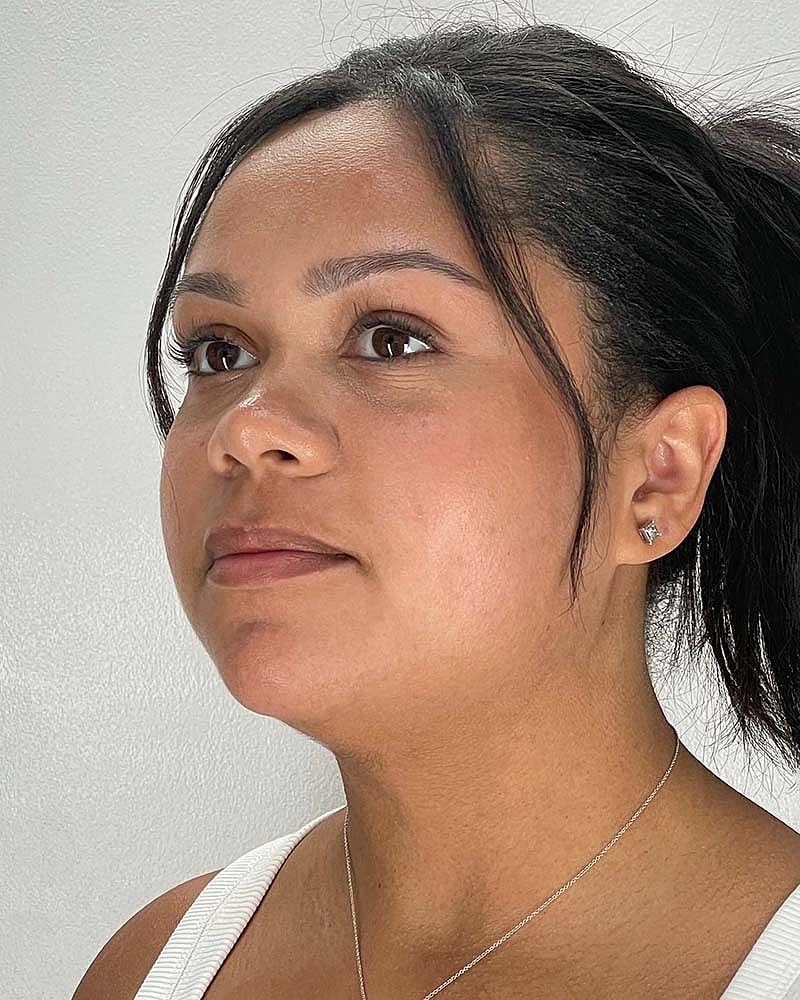 Chin Liposuction Before & After