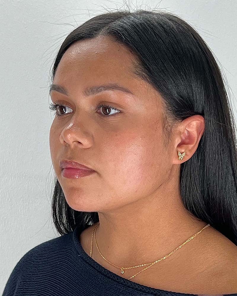 Chin Liposuction Before & After