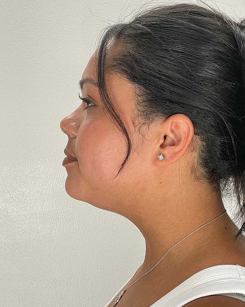 Chin Liposuction Before & After