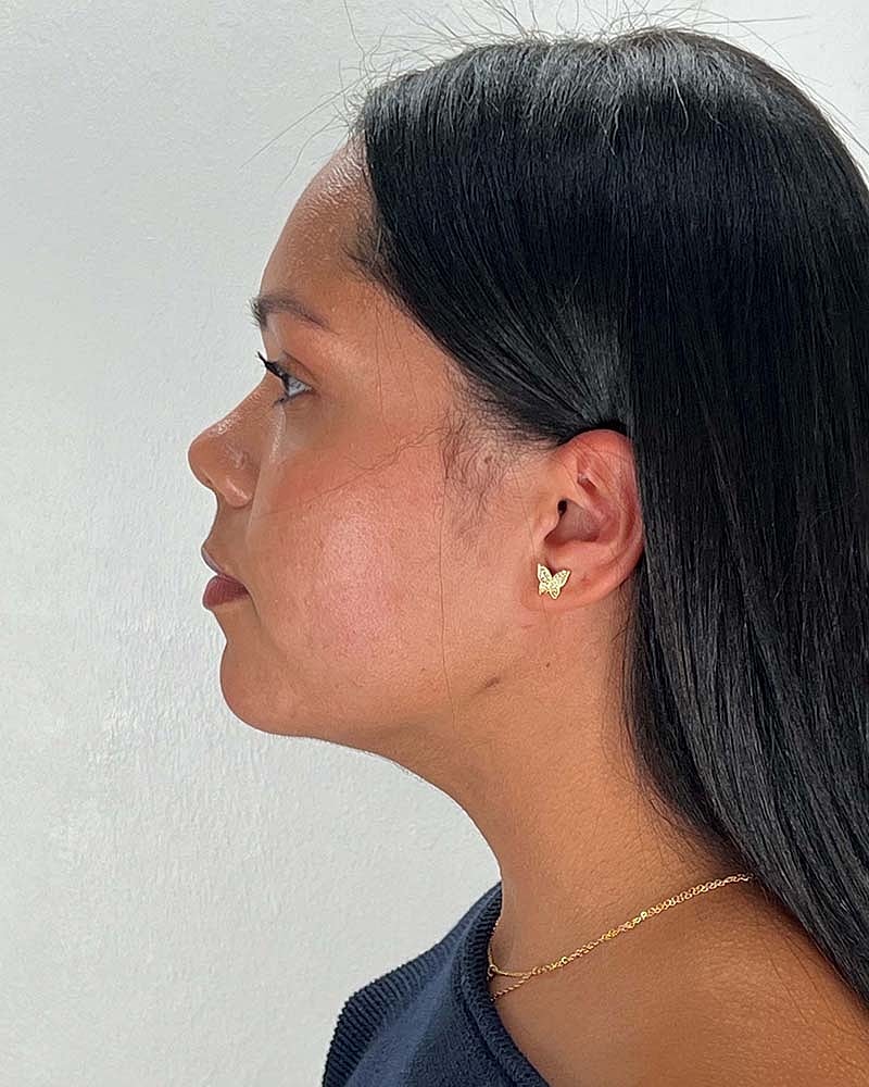 Chin Liposuction Before & After