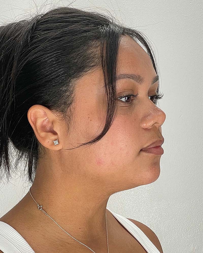 Chin Liposuction Before & After