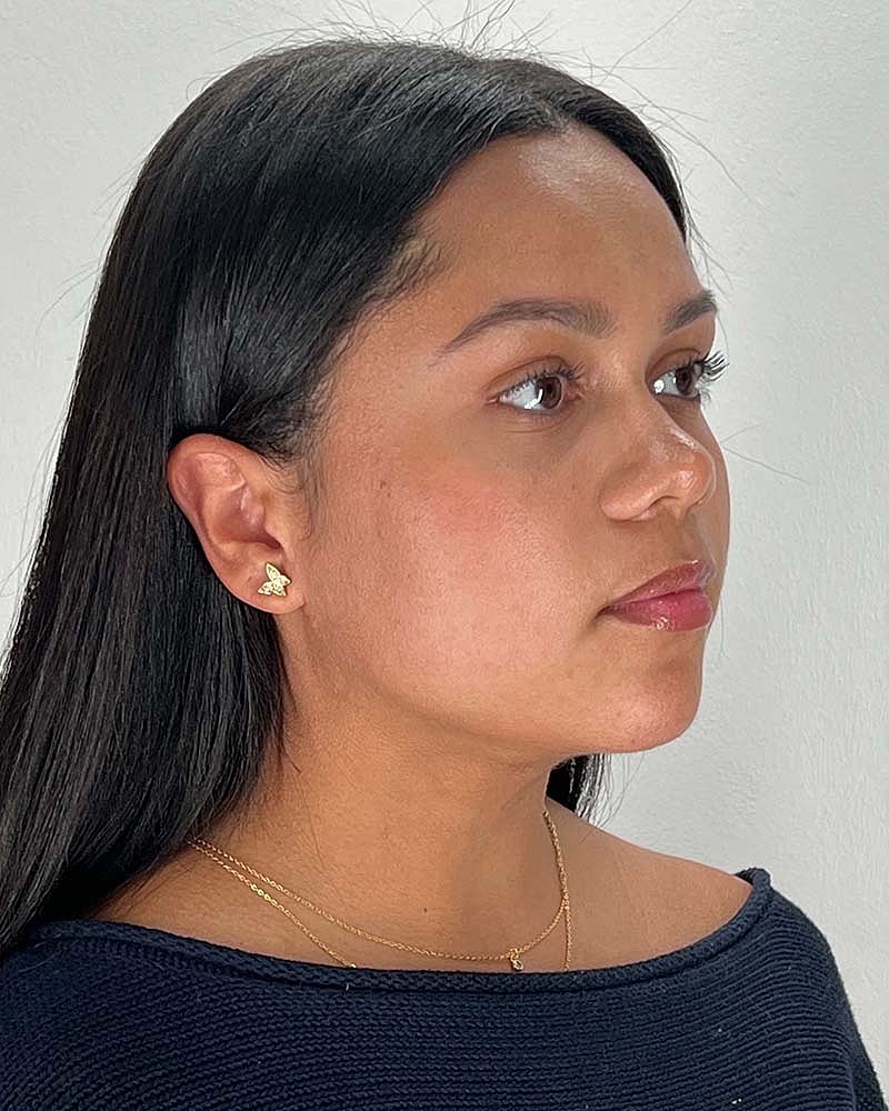 Chin Liposuction Before & After