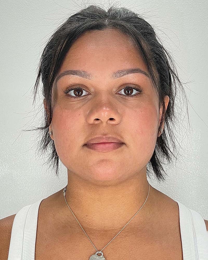 Chin Liposuction Before & After