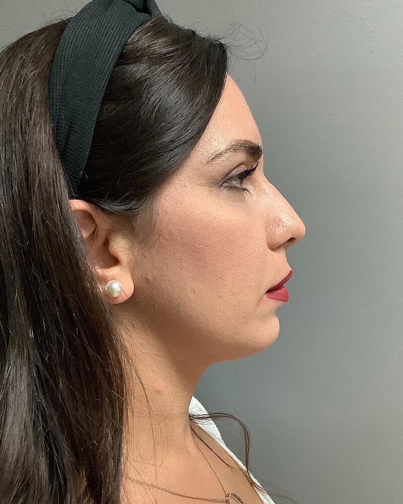 Chin Liposuction Before & After