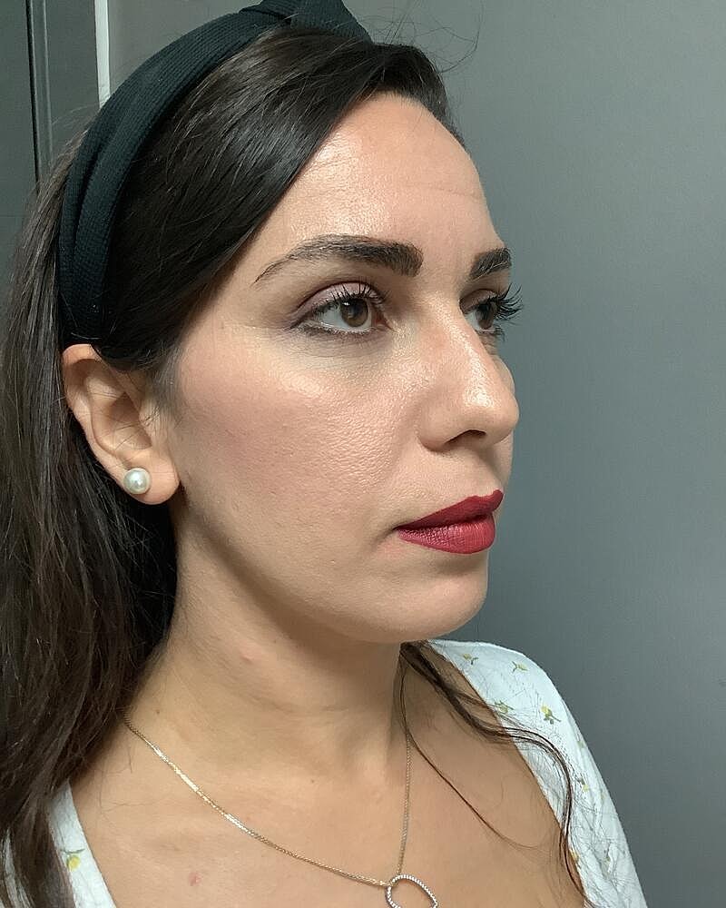 Chin Liposuction Before & After
