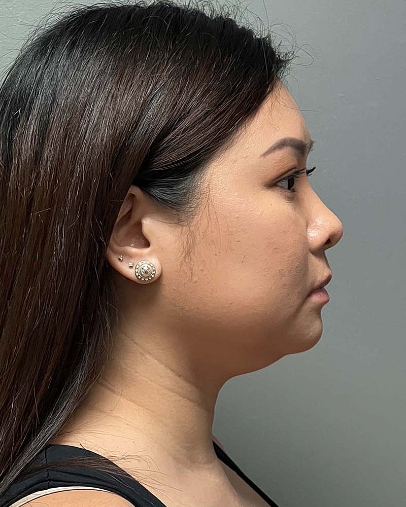 Chin Liposuction Before & After