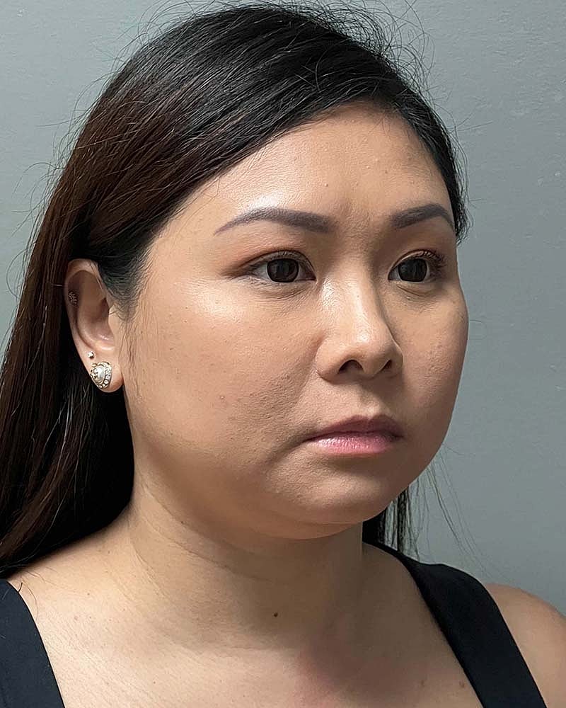 Chin Liposuction Before & After