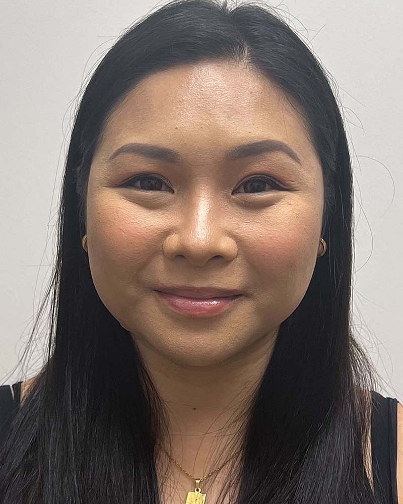 Chin Liposuction Before & After