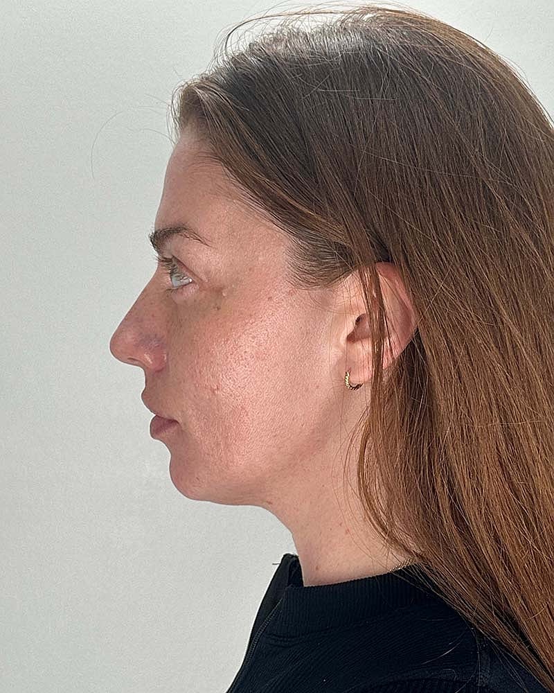 Chin Liposuction Before & After