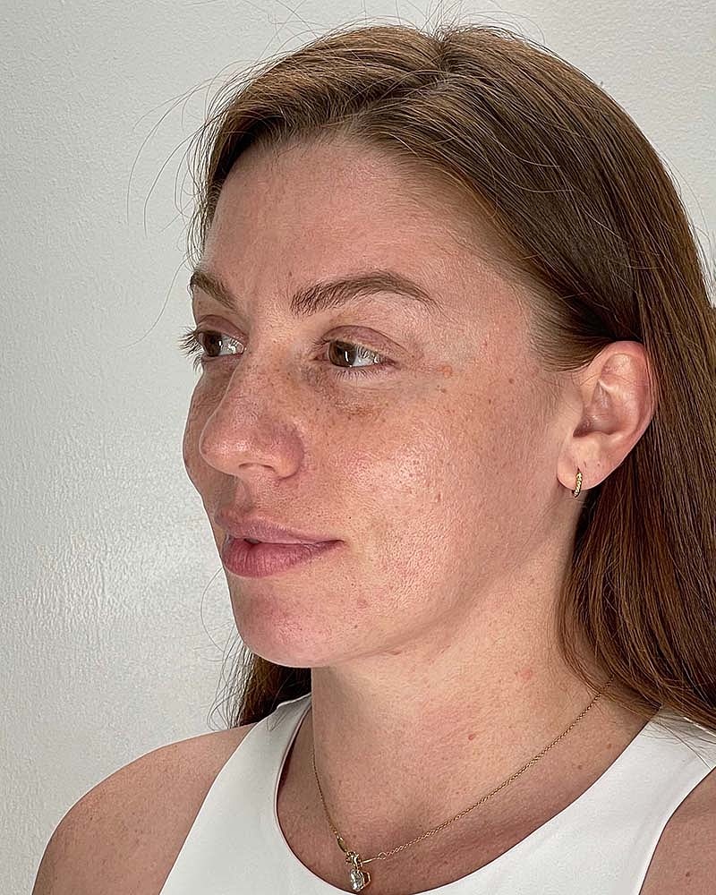 Chin Liposuction Before & After