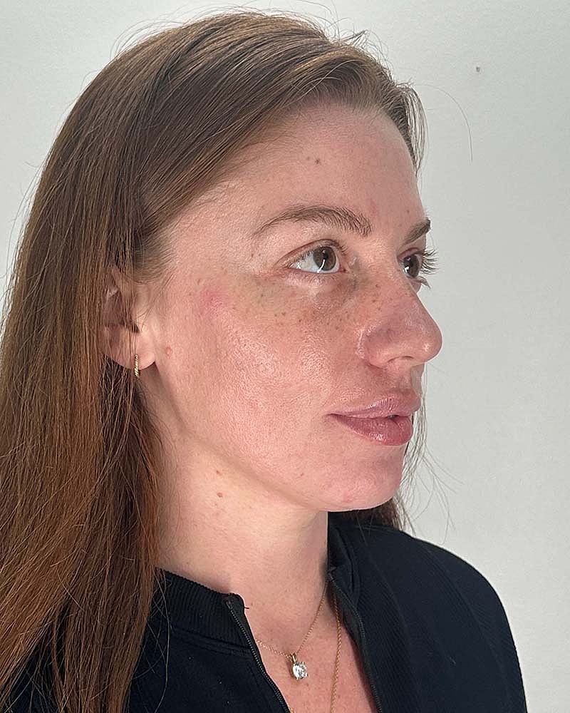 Chin Liposuction Before & After