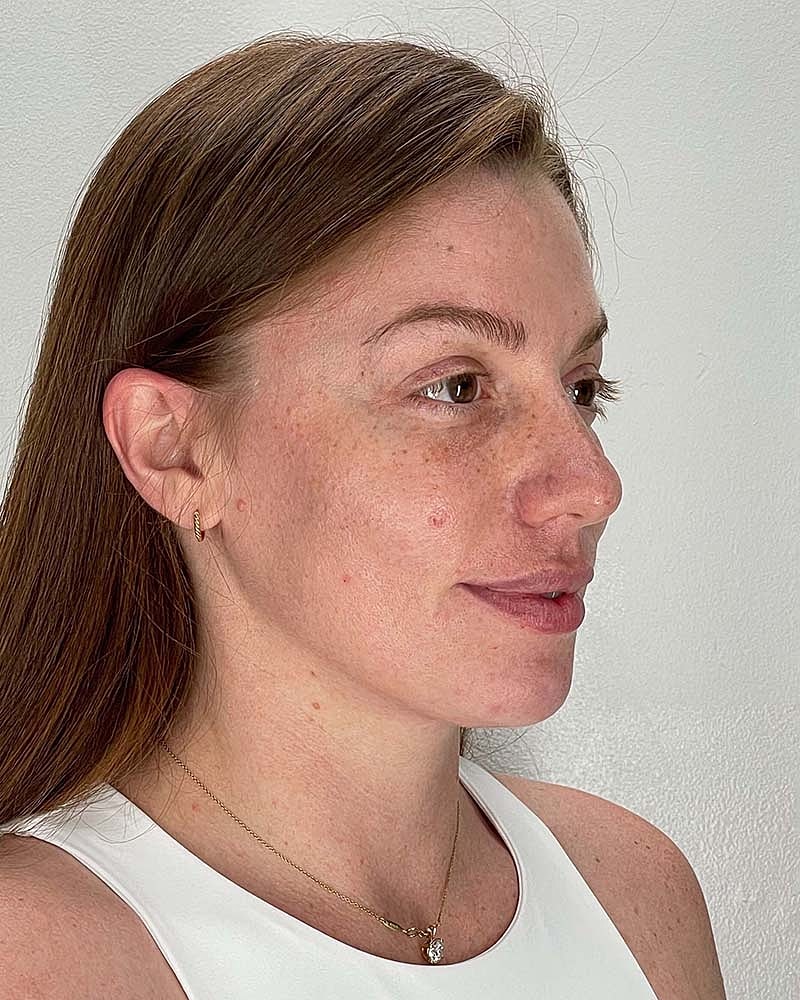 Chin Liposuction Before & After