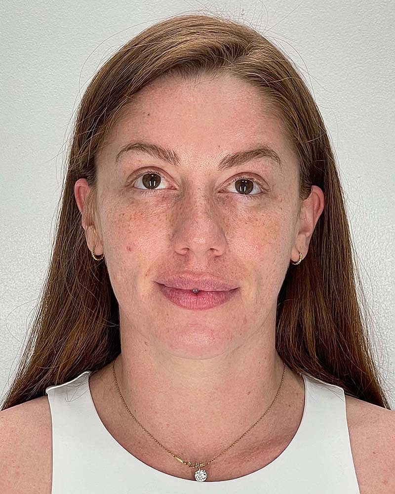 Chin Liposuction Before & After
