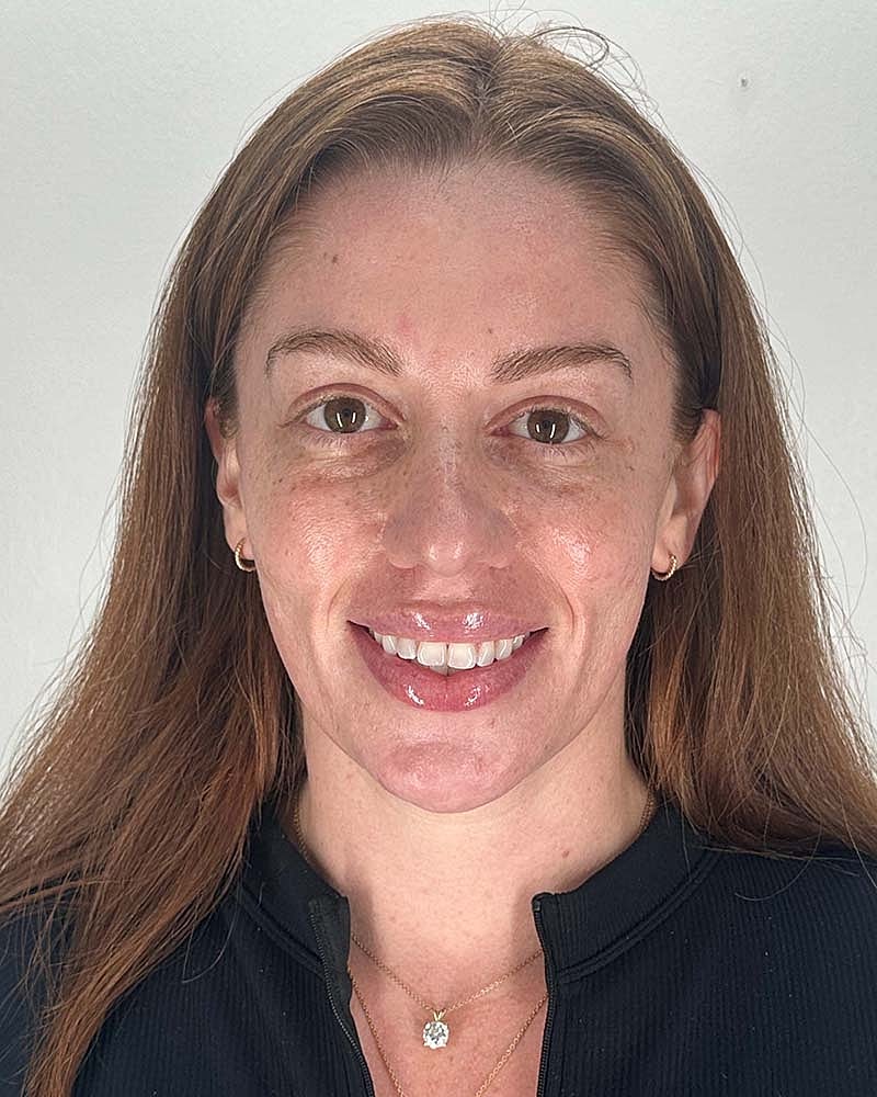 Chin Liposuction Before & After