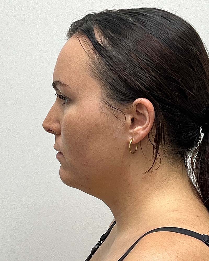 Chin Liposuction Before & After