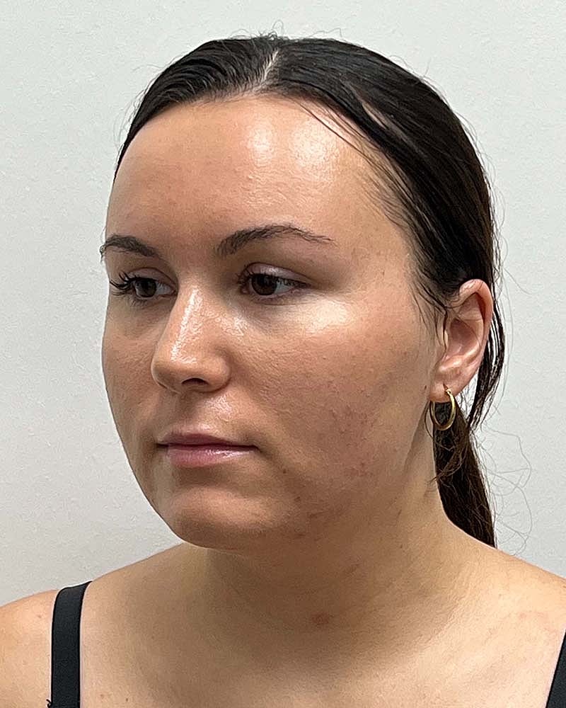 Chin Liposuction Before & After