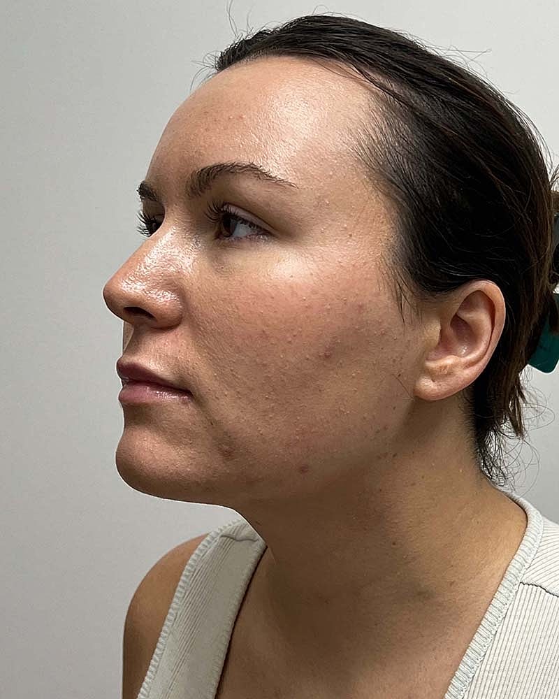Chin Liposuction Before & After