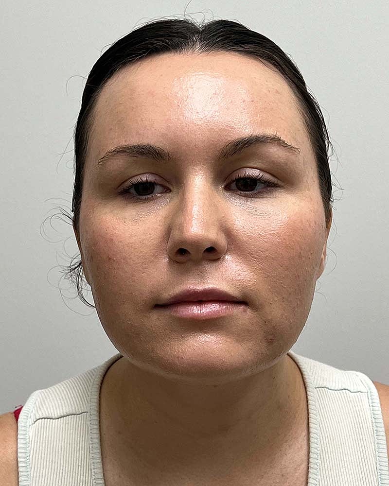 Chin Liposuction Before & After