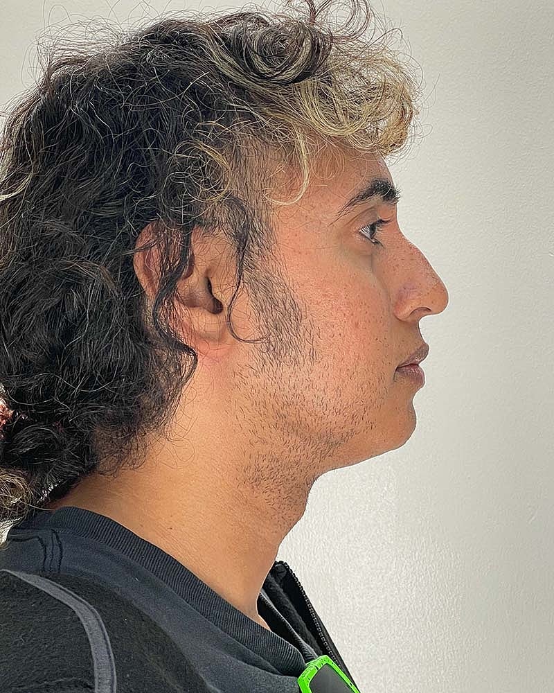 Chin Liposuction Before & After