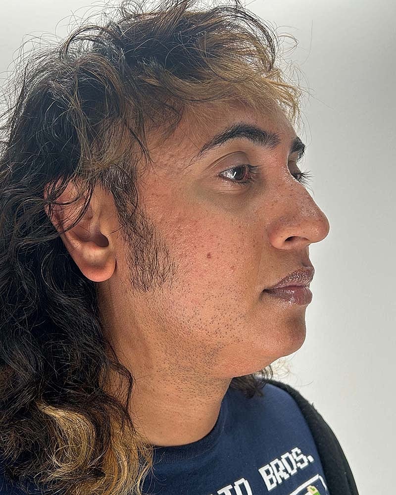 Chin Liposuction Before & After