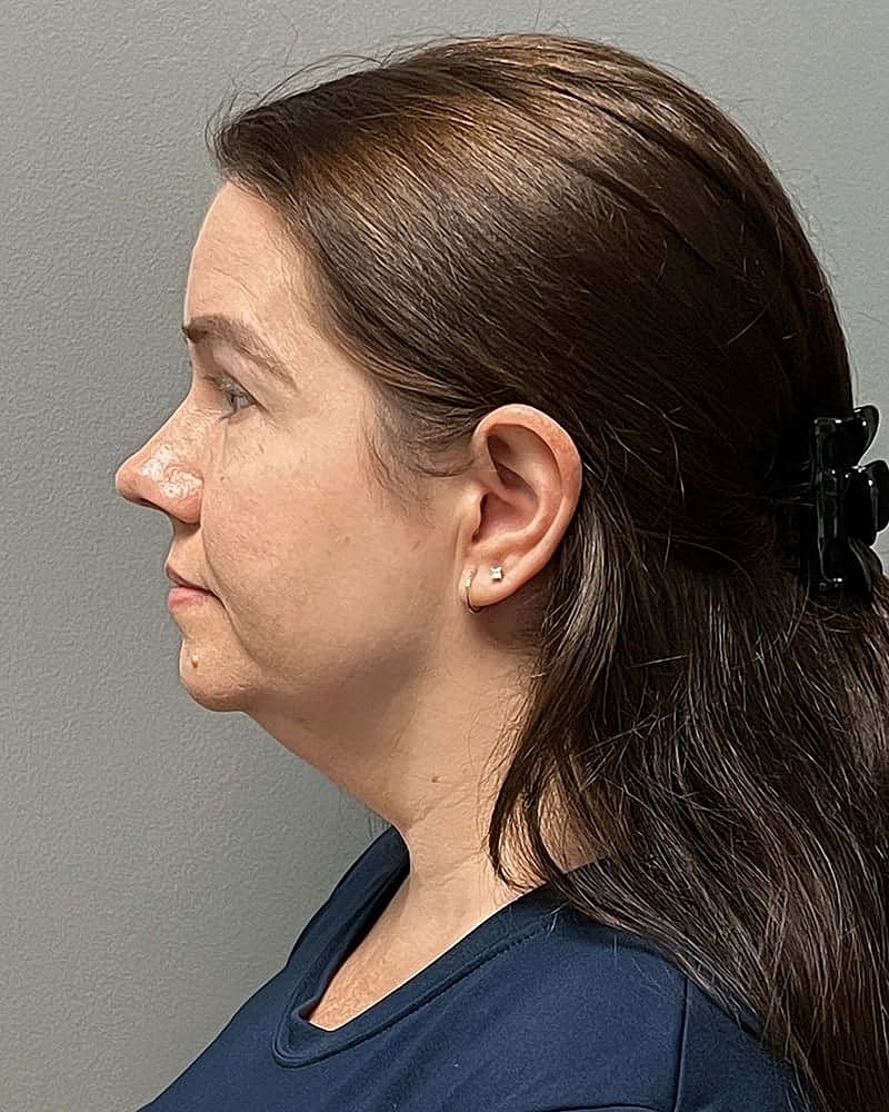 Chin Liposuction Before & After