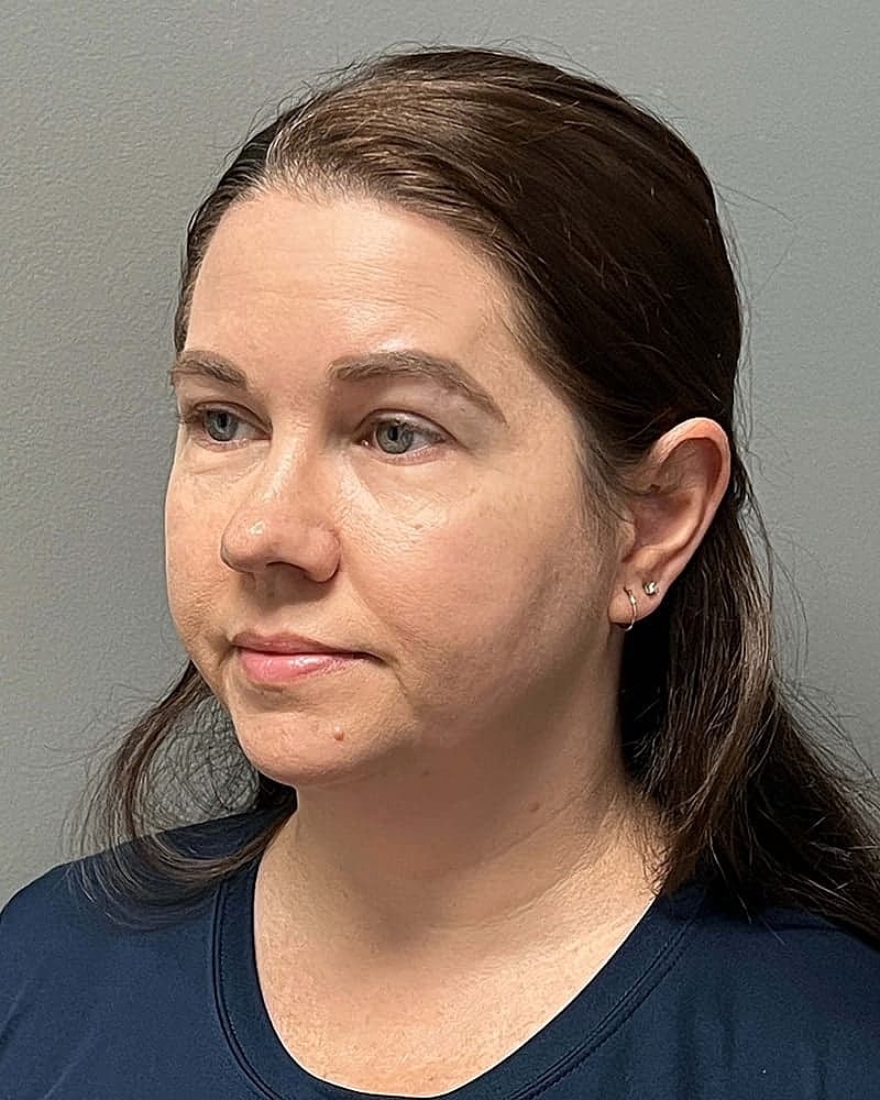 Chin Liposuction Before & After