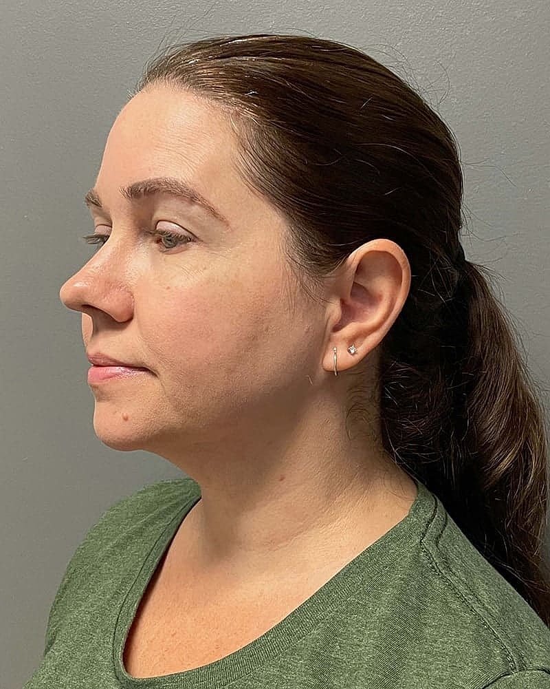 Chin Liposuction Before & After