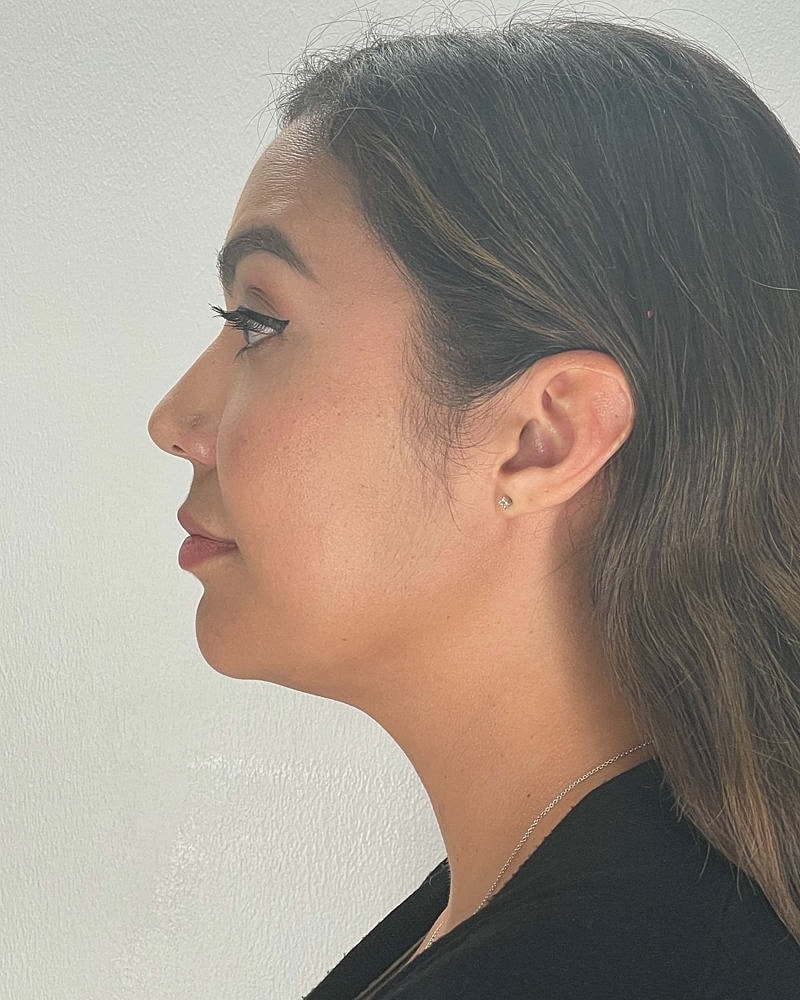 Chin Liposuction Before & After