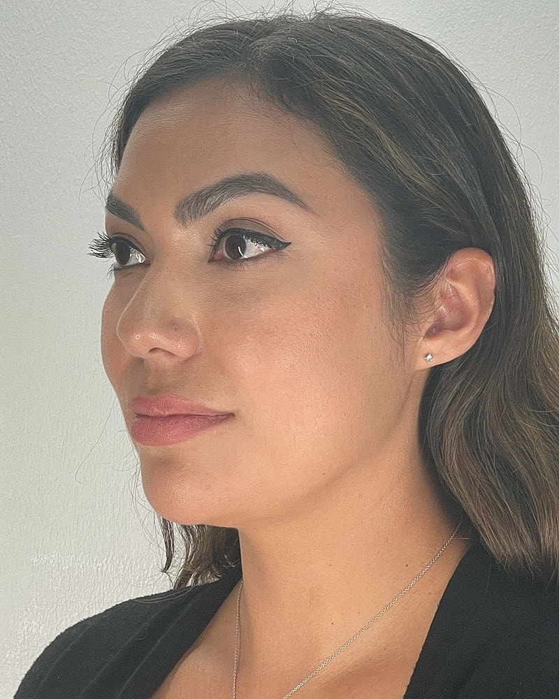 Chin Liposuction Before & After