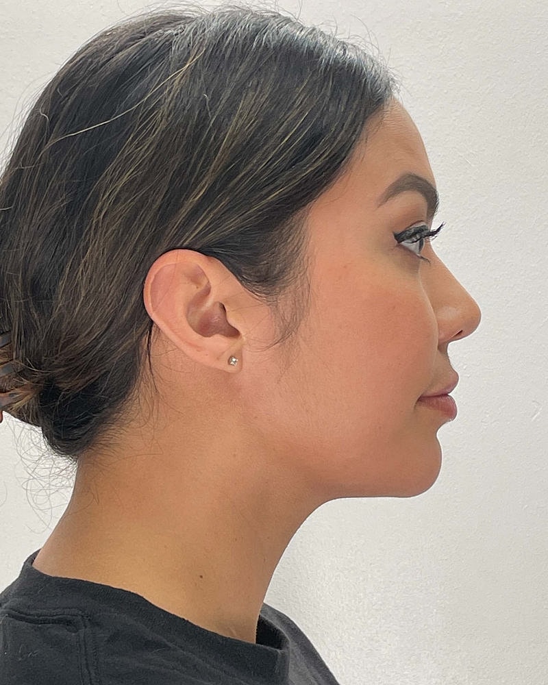 Chin Liposuction Before & After