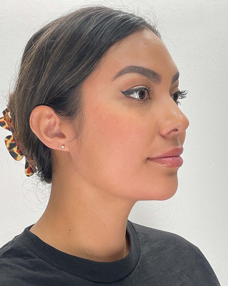 Chin Liposuction Before & After