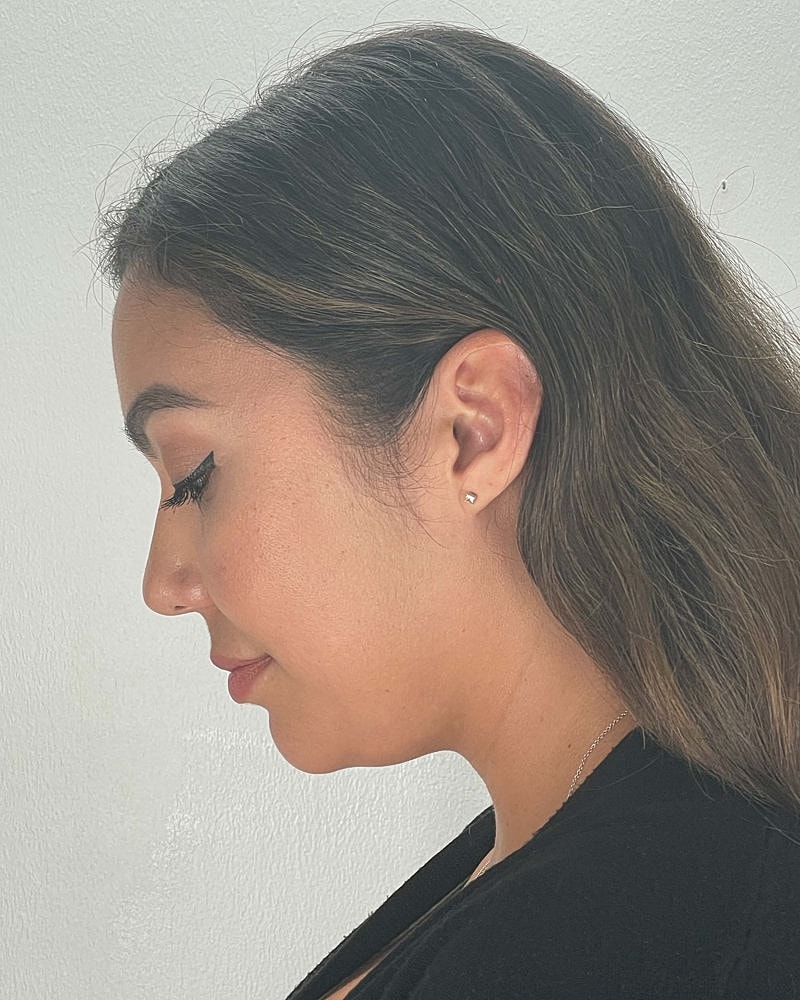 Chin Liposuction Before & After