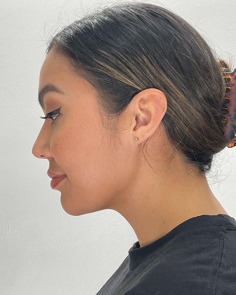 Chin Liposuction Before & After