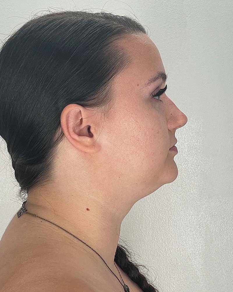 Chin Liposuction Before & After