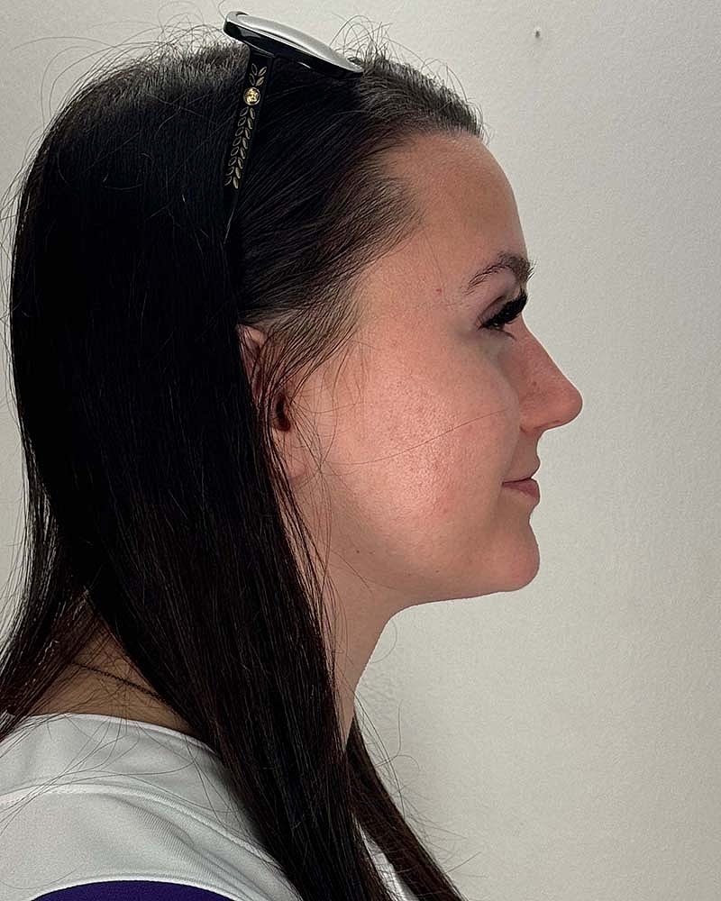 Chin Liposuction Before & After