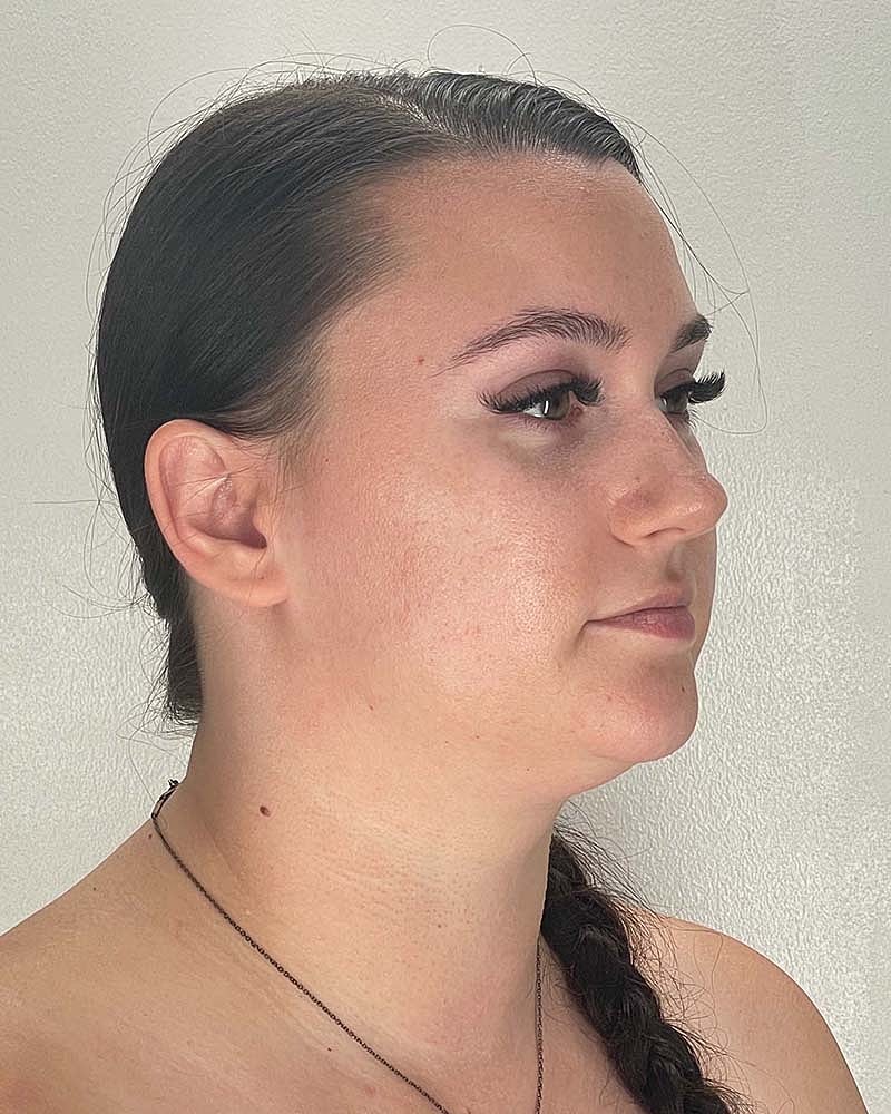 Chin Liposuction Before & After