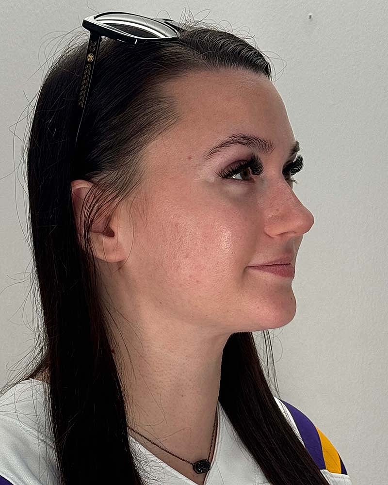Chin Liposuction Before & After
