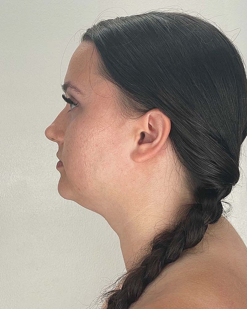 Chin Liposuction Before & After