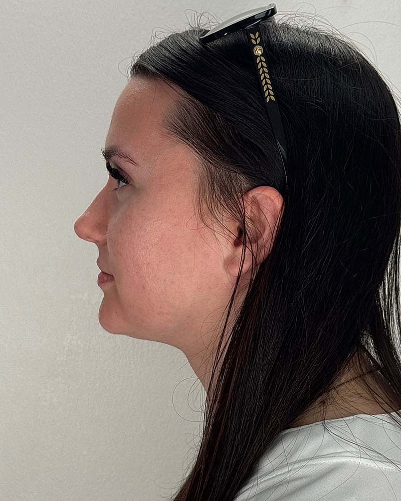 Chin Liposuction Before & After