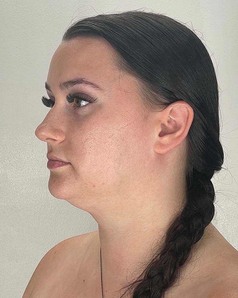 Chin Liposuction Before & After